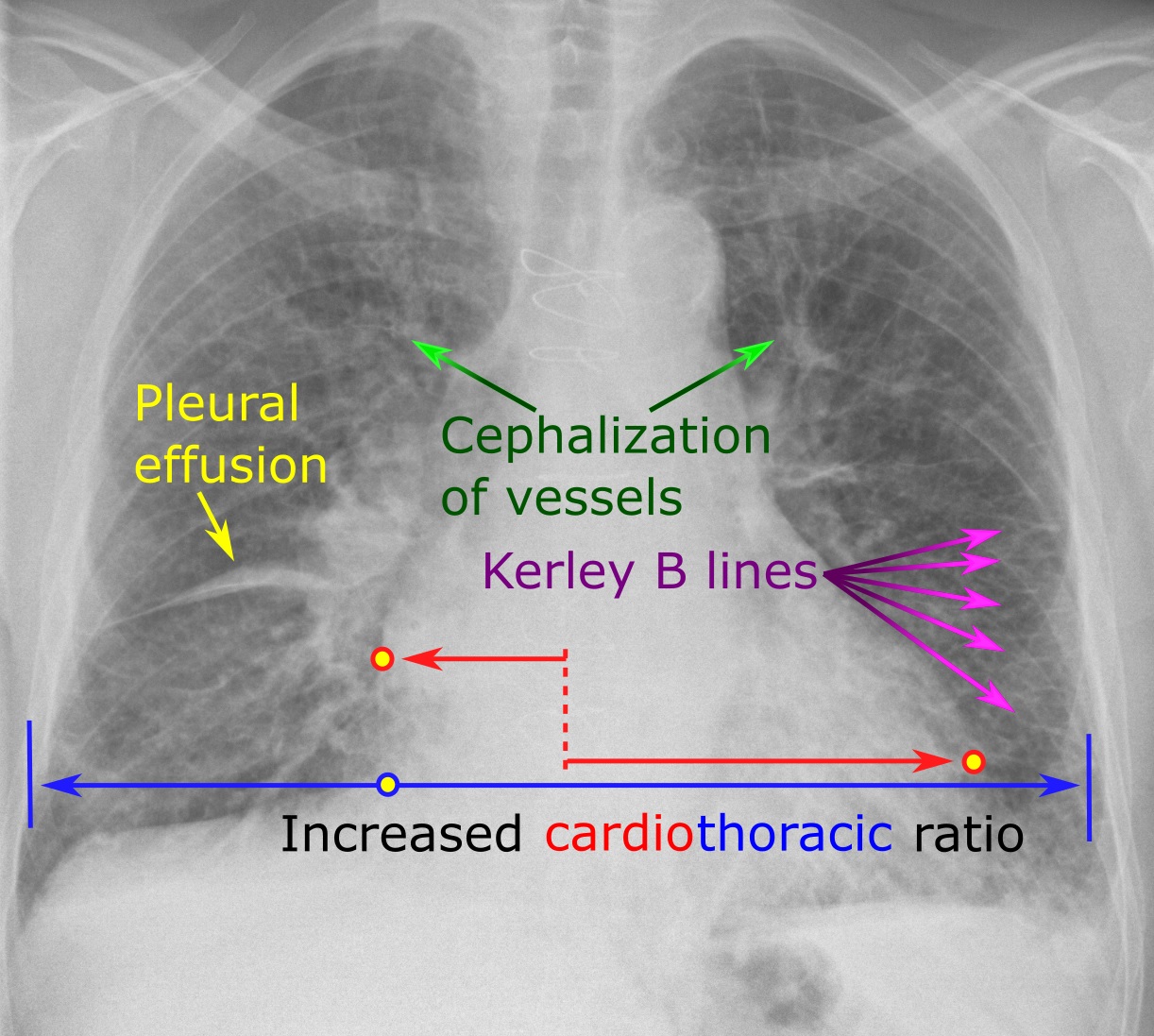 hemodynamic-aspects-of-cardiogenic-shock-case-based-discussion-medcase