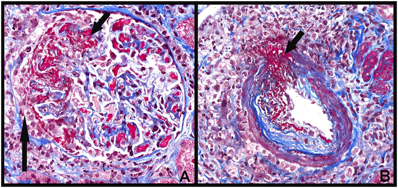Васкулит гломерулонефрит. Мезангиопролиферативный гломерулонефрит. Анца васкулит. Криоглобулинемический гломерулонефрит. Геморрагический васкулит суставная форма.